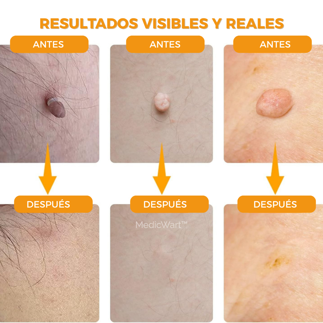 MedicWart: Kit Eliminación de Verrugas Sin Dolor