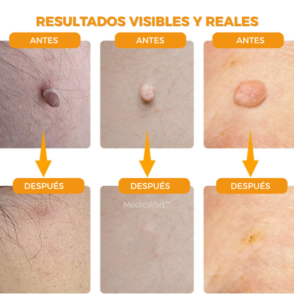 MedicWart: Kit Eliminación de Verrugas Sin Dolor