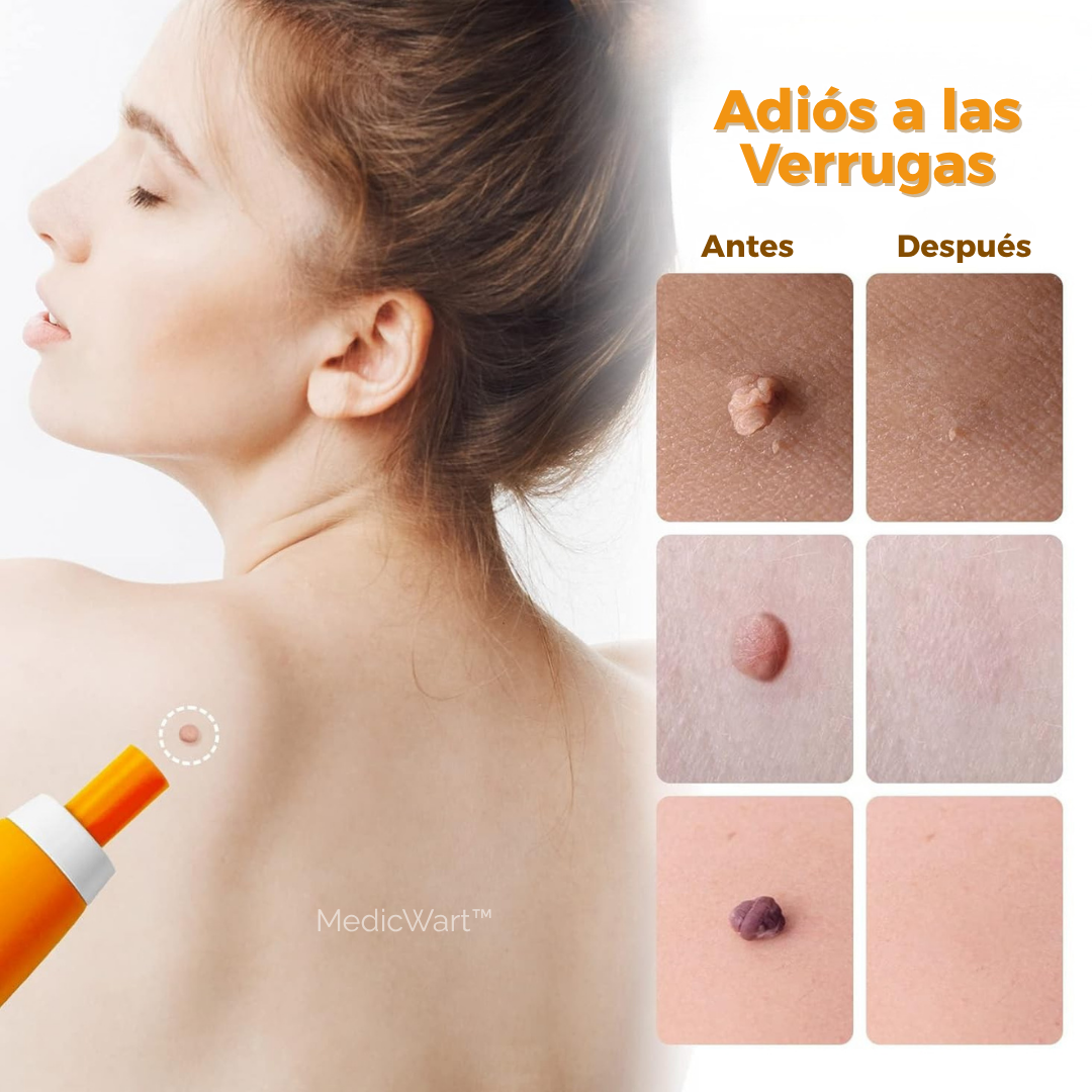 MedicWart: Kit Eliminación de Verrugas Sin Dolor